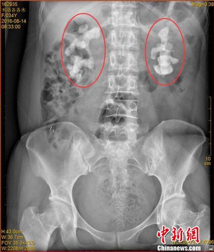 四川一女子喝生水30余年双肾长10厘米巨型结石