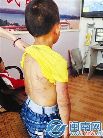男孩的后背和手臂被母亲打得满是伤痕