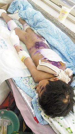 遭虐待遍体鳞伤的彤彤。本报记者 汪洋 摄