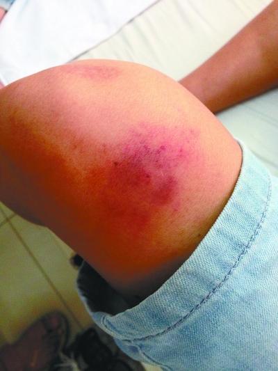 刘成左膝盖的针眼 通讯员赵林 摄  刘成左膝盖的针眼 通讯员赵林 摄