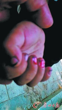 男孩的手指血肉模糊。