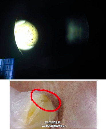 杭州女子到东非旅游感染人肤蝇-手臂竟爬出虫子3