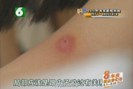 皮肤蝇2 皮肤蝇2