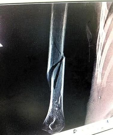 男童骨折照片 男童骨折照片