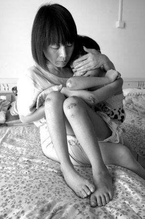 　女童的外伤基本痊愈，但留下了明显的疤痕。京华时报记者蒲东峰摄