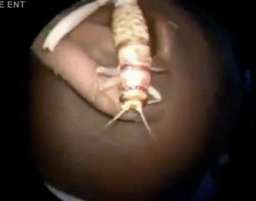 图为男子耳中的蟋蟀 图为男子耳中的蟋蟀