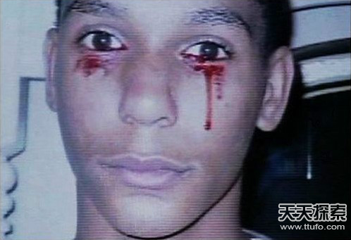 这位少年哭泣时会哭出血来 这位少年哭泣时会哭出血来