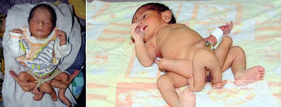 巴基斯坦一6腿婴儿降生 诊断称患有罕见遗传病 巴基斯坦一6腿婴儿降生 诊断称患有罕见遗传病
