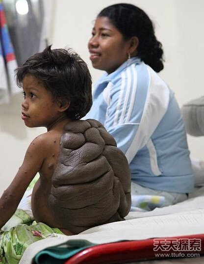 哥伦比亚男童患“乌龟背” 成功脱除 哥伦比亚男童患“乌龟背” 成功脱除