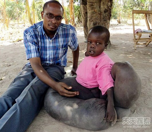 非洲男孩感染食肉菌双腿肿如象腿 非洲男孩感染食肉菌双腿肿如象腿