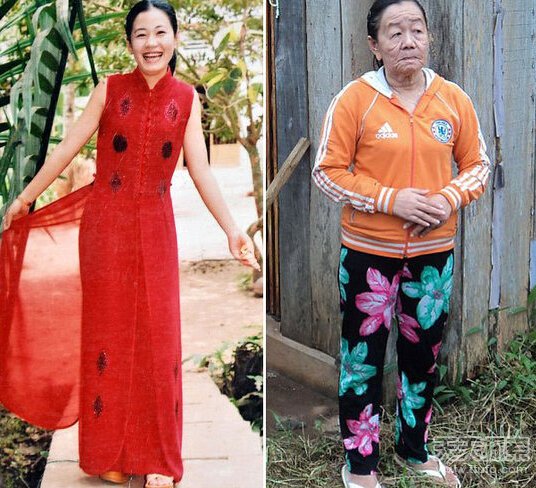 越南一女子过敏后患怪病 短时间内衰老50岁 越南一女子过敏后患怪病 短时间内衰老50岁