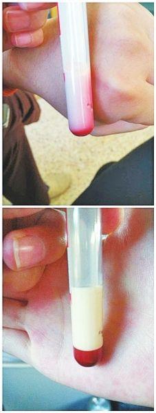 婴儿血液乳白色2 婴儿血液乳白色2