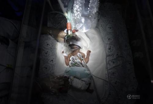 婴儿只有660克重、28公分长，跟一根筷子的长短差不多。因为妈妈的胎盘前置，她便迫不及待的来到了这个世界，比足月出生早了15周。