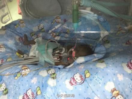 重庆筷子宝宝离世 中国最小早产婴仅活19天(图)