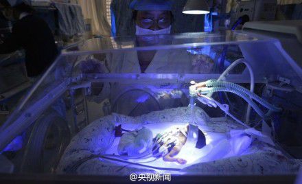 重庆筷子宝宝离世 中国最小早产婴仅活19天(图)