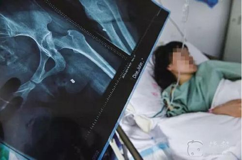 女子阳台遭枪击-臀部中弹深达20厘米2 女子阳台遭枪击-臀部中弹深达20厘米2