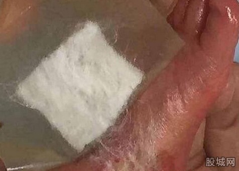 婴儿小脚被灼伤 婴儿小脚被灼伤