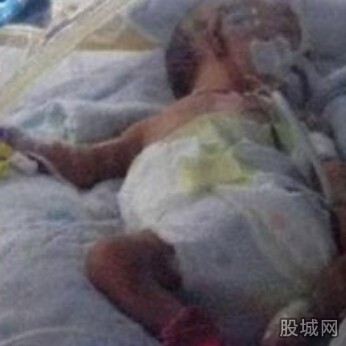 早产儿烧伤 早产儿烧伤