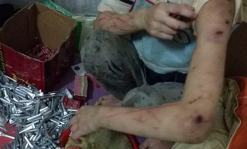 两个孩子遍体鳞伤，浑身都是斑斑点点的淤青和伤痕，从手到脚、前胸后背、大腿、腹部几乎找不到一块好皮肤。小琳的右脸颊还有一大片延至眼窝的淤青，左脸颊下侧和两条手臂则是横七竖八的血痕和血痂，惨不忍睹。