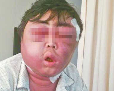 张先生面部肿胀得眼睛都睁不开 张先生面部肿胀得眼睛都睁不开