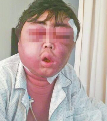 男子被蚊子叮脸肿成球  男子被蚊子叮脸肿成球