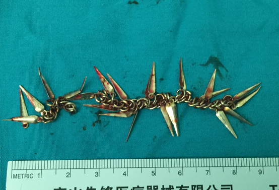 医院取出2岁患儿体内9厘米异物 医院取出2岁患儿体内9厘米异物