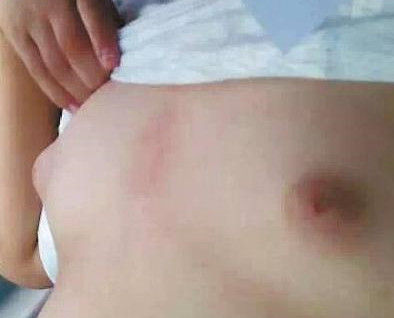 初二男生爱吃炸鸡排 乳房发育如少女 初二男生爱吃炸鸡排 乳房发育如少女