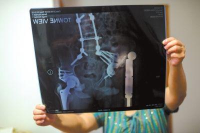 男子患病17年体内布满钢钉 自称“钢铁侠”(图)2 男子患病17年体内布满钢钉 自称“钢铁侠”(图)2