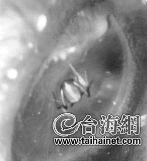 女子耳内夹出蜘蛛 女子耳内夹出蜘蛛