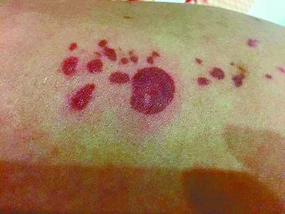 女子拆冰月饼礼盒 白色晶体掉落双腿被冻伤 女子拆冰月饼礼盒 白色晶体掉落双腿被冻伤