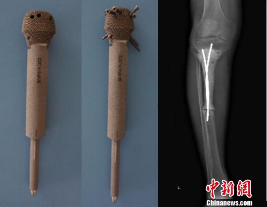 3D打印关节假体植入骨癌患者 19岁小伙术后伸展自如1 3D打印关节假体植入骨癌患者 19岁小伙术后伸展自如1