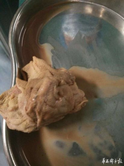 女子产后纱布留体内痛三年 律师称医院应赔偿(图)1 女子产后纱布留体内痛三年 律师称医院应赔偿(图)1