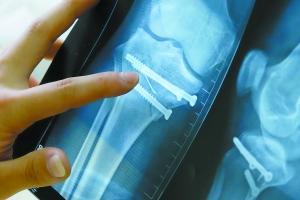 男子膝盖手术后半年不消肿 探针断裂留在骨头中 男子膝盖手术后半年不消肿 探针断裂留在骨头中