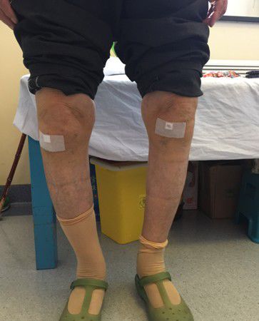 膝关节问题的根本是“肝肾亏虚”？