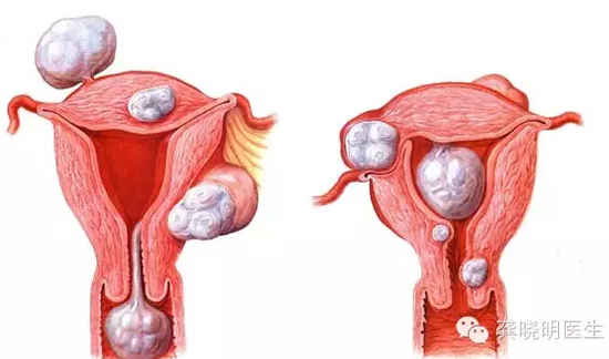 龚晓明:1/3女性都有的子宫肌瘤到底是啥