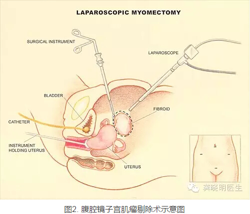 龚晓明:1/3女性都有的子宫肌瘤到底是啥