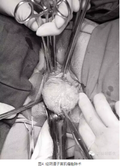 龚晓明:1/3女性都有的子宫肌瘤到底是啥