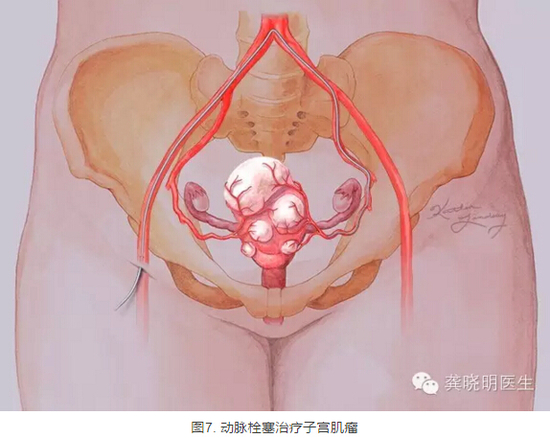 龚晓明:1/3女性都有的子宫肌瘤到底是啥