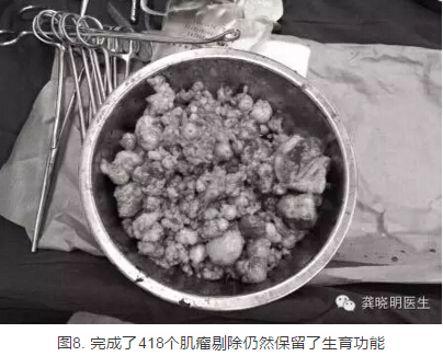 龚晓明:1/3女性都有的子宫肌瘤到底是啥