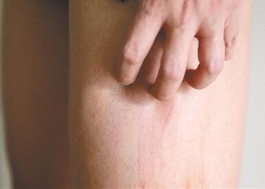 皮炎 湿疹是怎么引起 湿疹最佳治疗方法