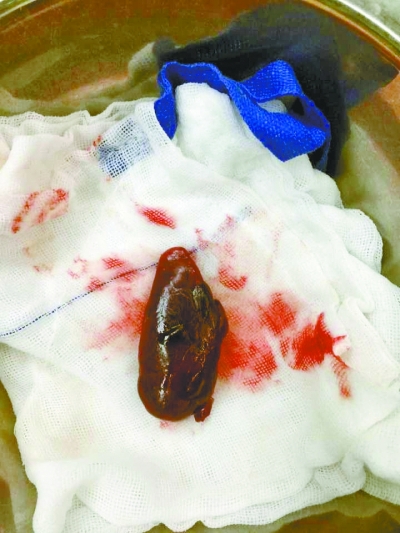 正常的甲状旁腺只有黄豆大，切下来的瘤子有金丝小枣大。