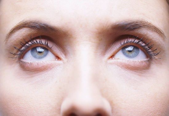 眼袋不是卧蚕！认清关于眼袋的五大误区