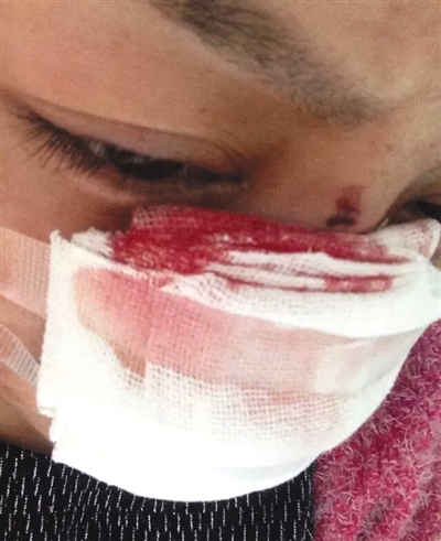 　李云鼻子被割后仍在治疗。网络截图