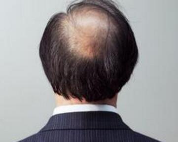 肾虚致脱发 掉发严重如何洗头?