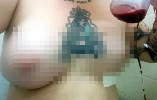 英国一名女子去隆乳，从A罩杯升级到F罩杯，没想到一周后左胸竟然“泄气”。