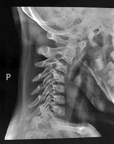 10岁女孩每天低头玩手机 颈椎“折”了