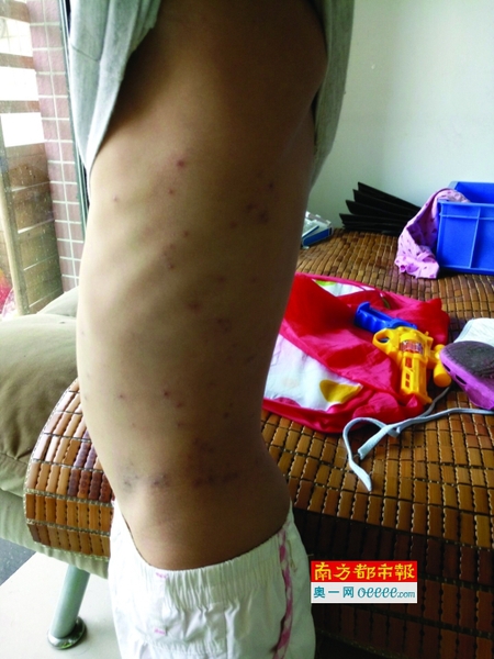 陈俊皓身上起了不少红疙瘩，奇痒无比