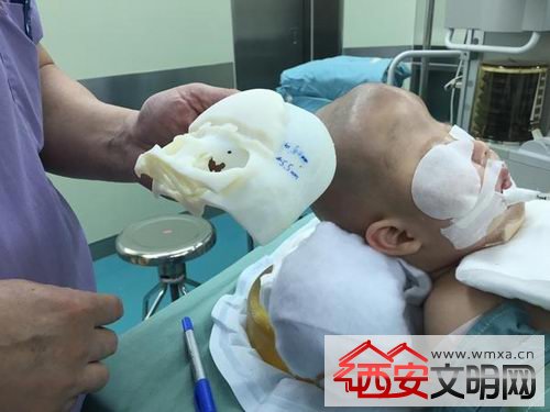 男婴小宇(化名)患有严重的狭颅症