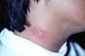 为什么年轻人也会得“带状疱疹”？