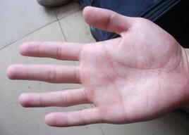 看手掌便知高血压？如何调理防治高血压